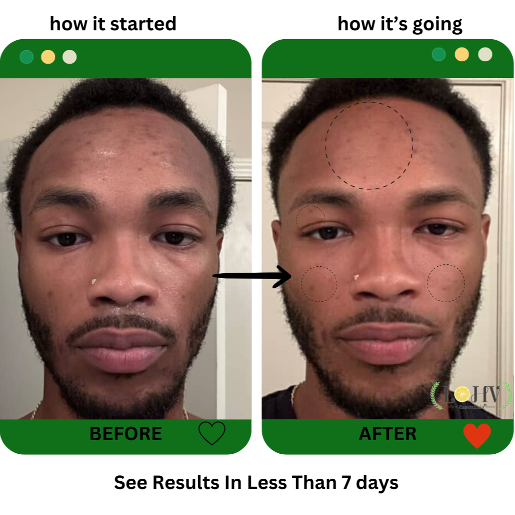 4 STEP PREMIUM 100% VEGAN SKINCARE SOLUTION SYSTEM With Rosemary + Hyaluronic acid + Vitamin C + Retinol + Lactic acid + Glycolic acid + Vitamin E + Niacinamide + Kombucha + Aloe vera