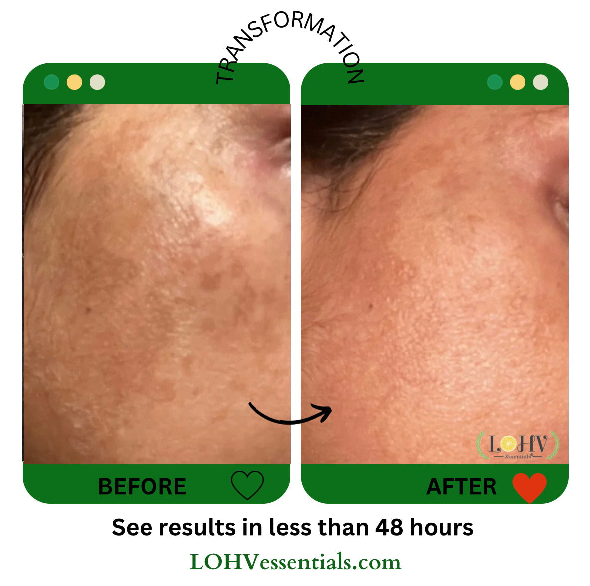 4 STEP PREMIUM 100% VEGAN SKINCARE SOLUTION SYSTEM With Rosemary + Hyaluronic acid + Vitamin C + Retinol + Lactic acid + Glycolic acid + Vitamin E + Niacinamide + Kombucha + Aloe vera